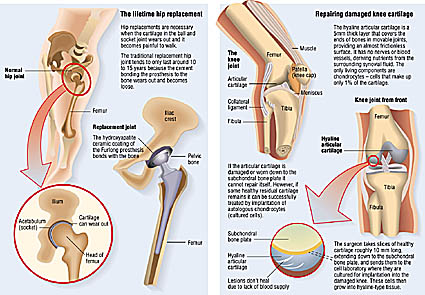 hip replacement diagram hip and knee medical illustrations