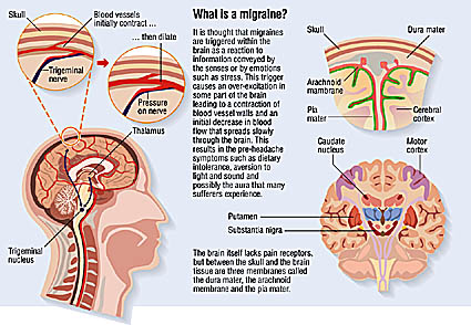 Medical diagram of migraine illustration of migraine artwork