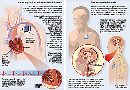 Medical illustration of brain stimulation diagram of brain stimulation
